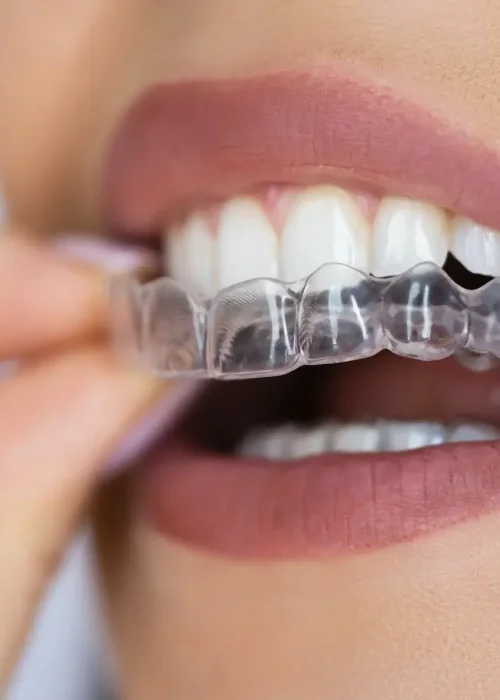 654b17f4a2fcfc932ebf32e7_sorriso-perfeito-invisalign-1200x1200-1